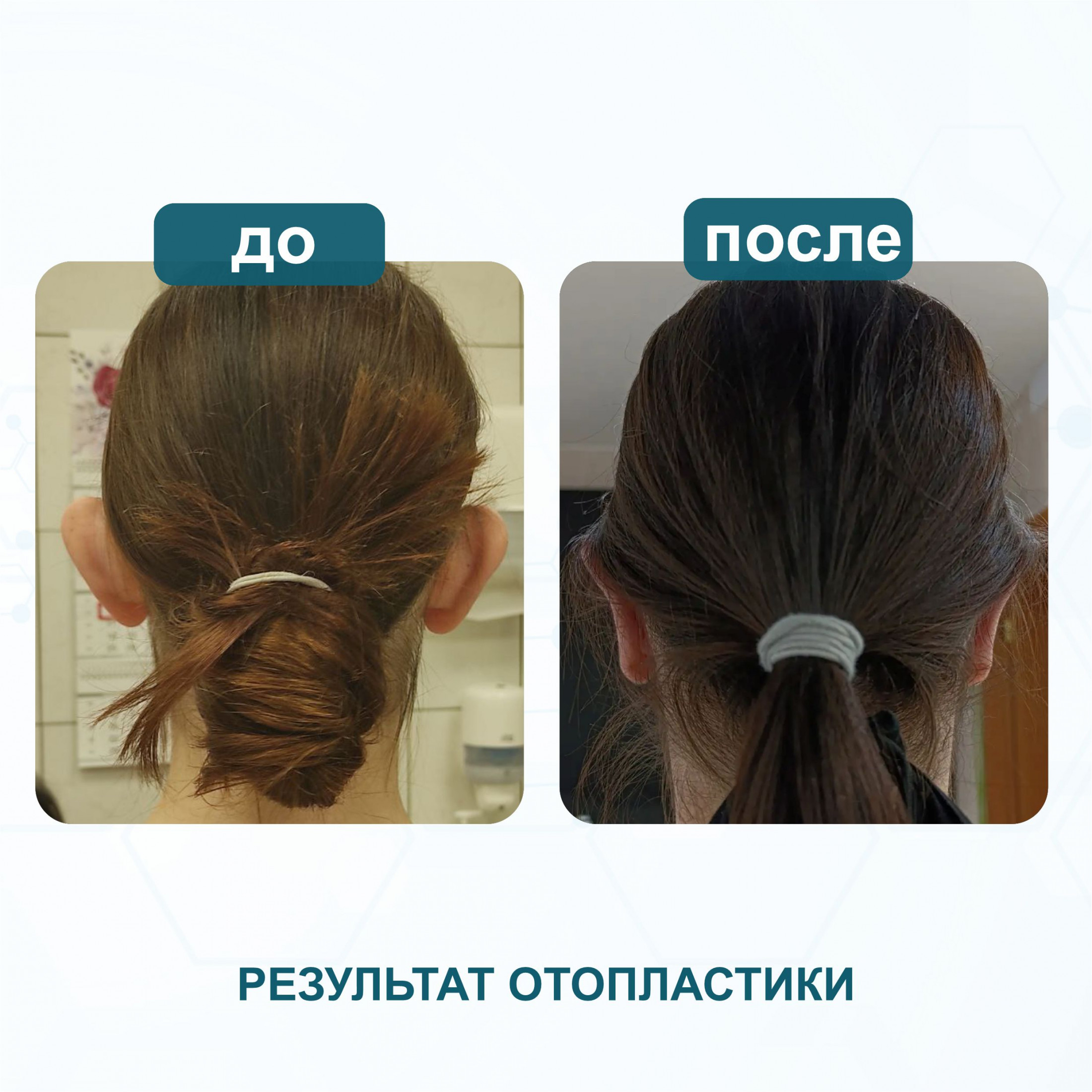 Результаты до и после отопластики